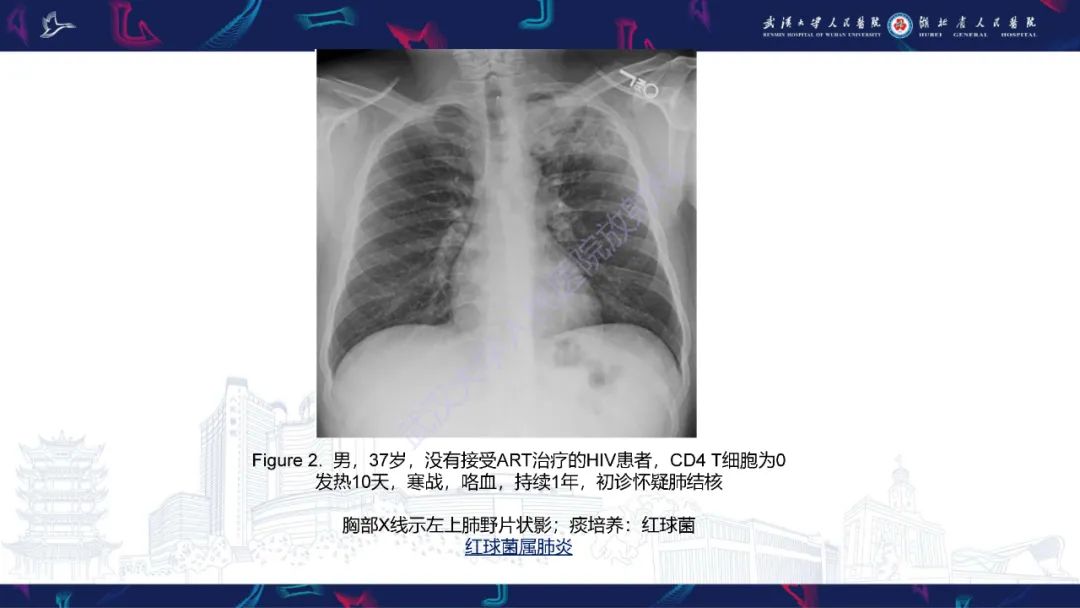 影像PPT - 【PPT】HIV/AIDS相关性胸部疾病影像诊断-6