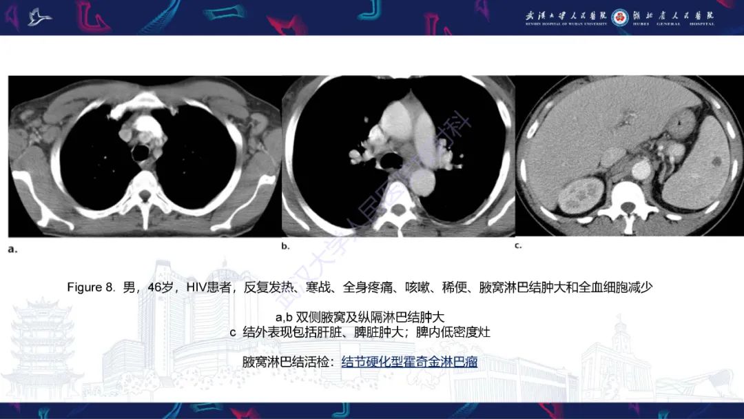 影像PPT - 【PPT】HIV/AIDS相关性胸部疾病影像诊断-12