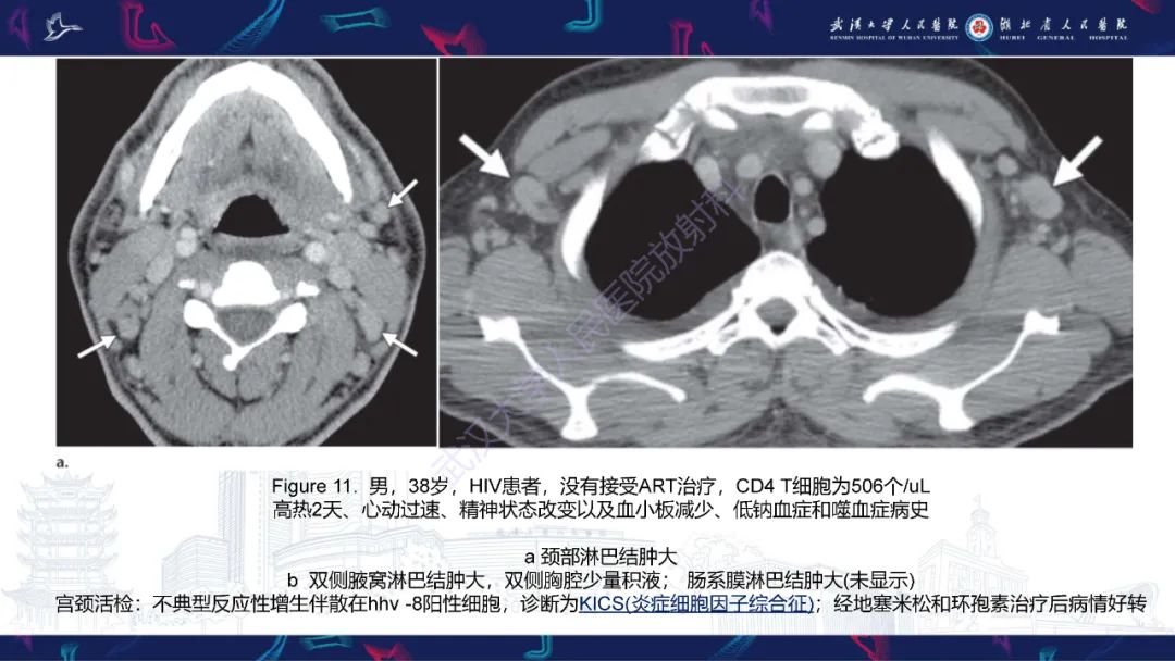 影像PPT - 【PPT】HIV/AIDS相关性胸部疾病影像诊断-16