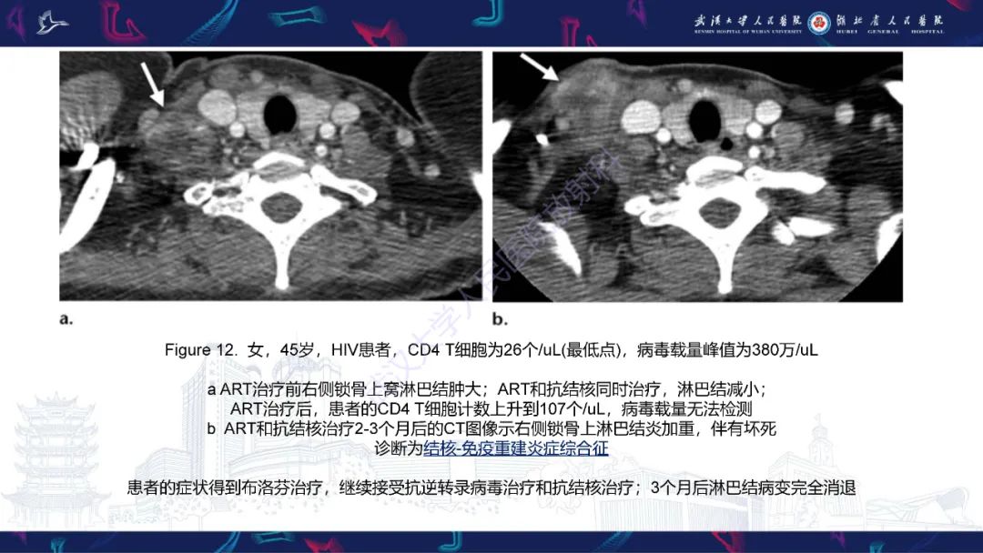 影像PPT - 【PPT】HIV/AIDS相关性胸部疾病影像诊断-18