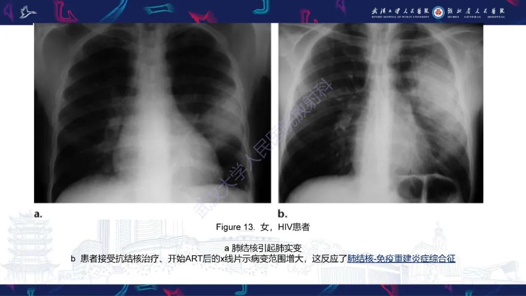 影像PPT - 【PPT】HIV/AIDS相关性胸部疾病影像诊断-19