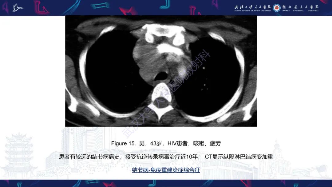 影像PPT - 【PPT】HIV/AIDS相关性胸部疾病影像诊断-21