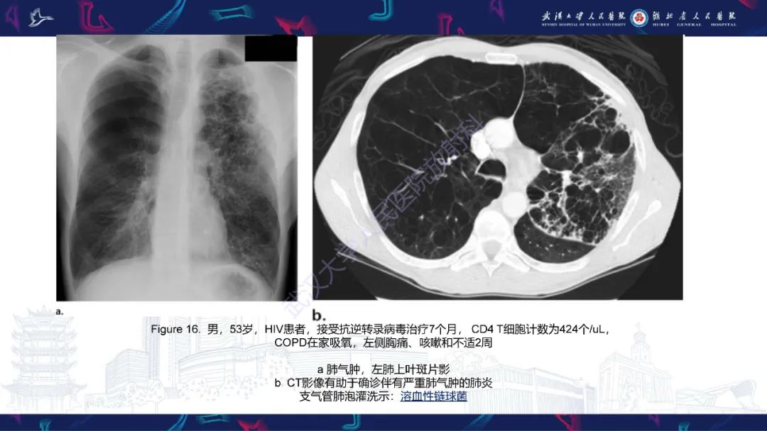 影像PPT - 【PPT】HIV/AIDS相关性胸部疾病影像诊断-23