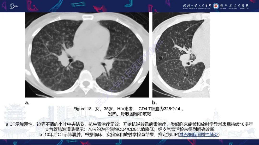 影像PPT - 【PPT】HIV/AIDS相关性胸部疾病影像诊断-26