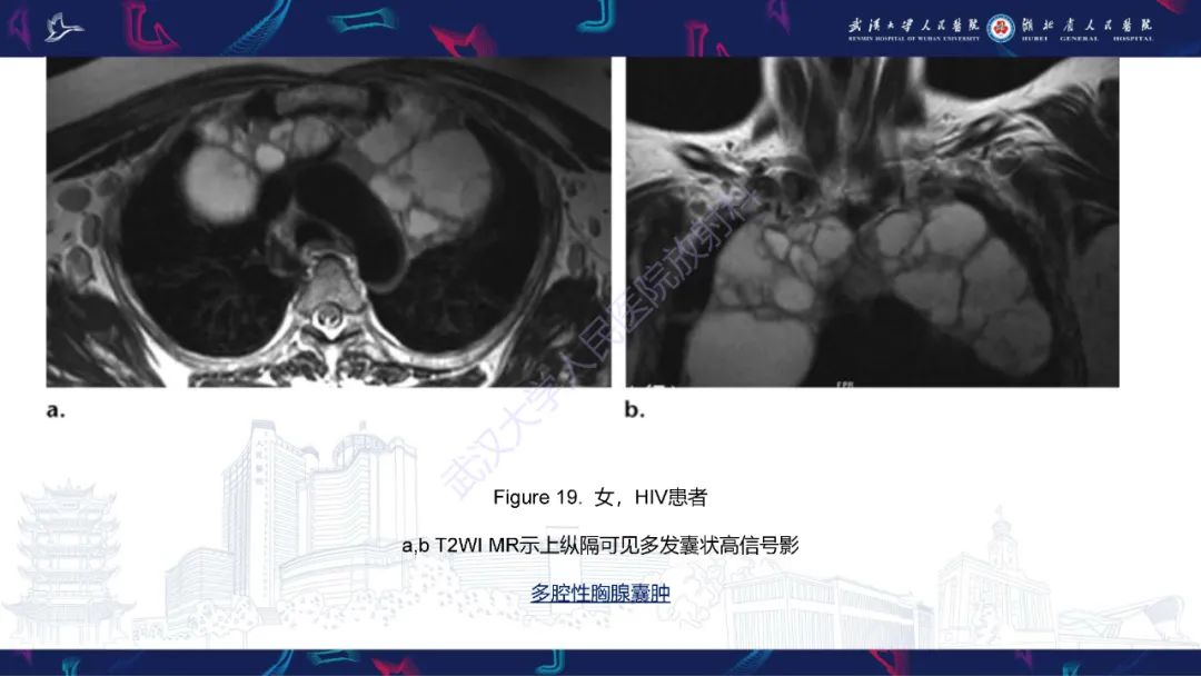 影像PPT - 【PPT】HIV/AIDS相关性胸部疾病影像诊断-27