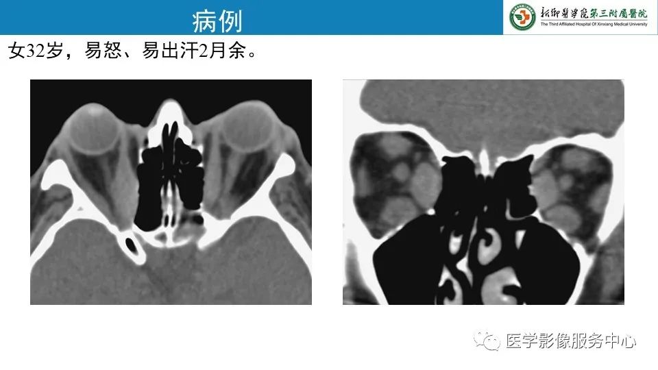 影像PPT - 【PPT】甲状腺免疫相关眼病-3