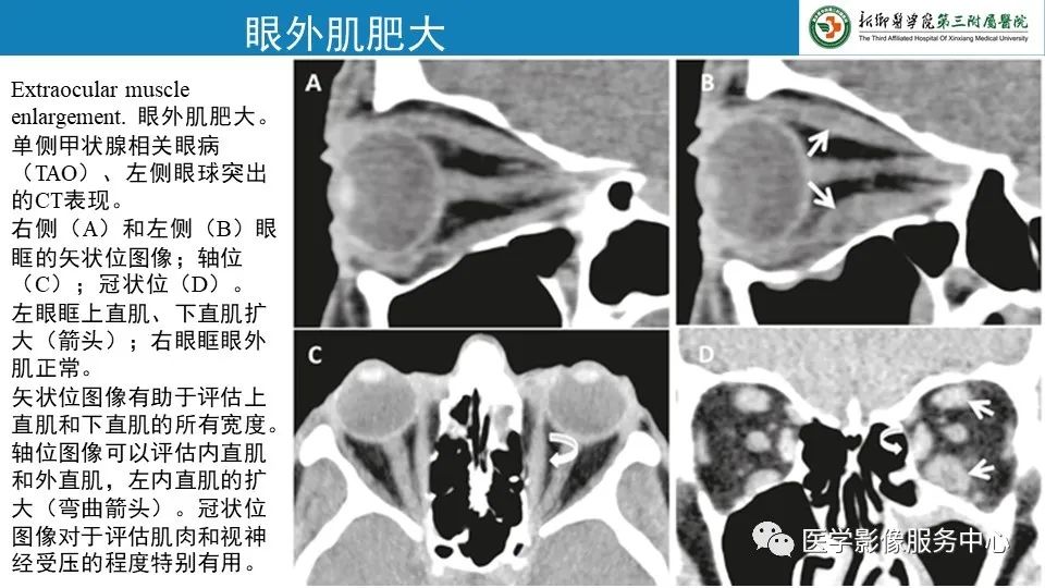 影像PPT - 【PPT】甲状腺免疫相关眼病-10