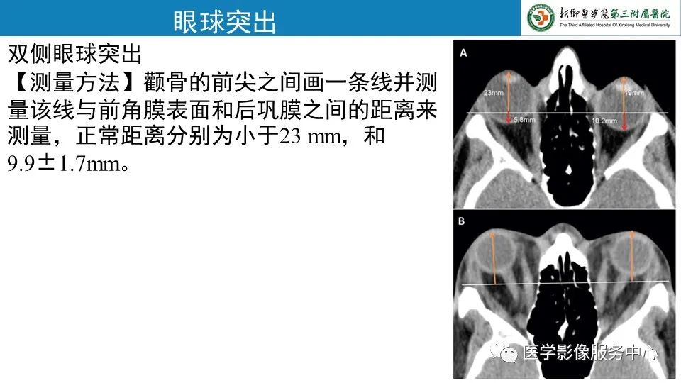 影像PPT - 【PPT】甲状腺免疫相关眼病-7