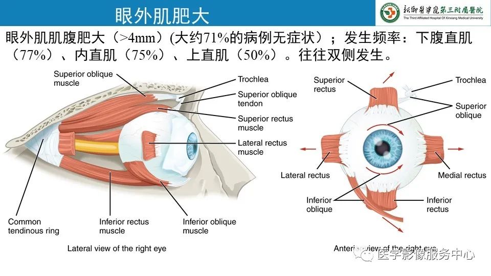 影像PPT - 【PPT】甲状腺免疫相关眼病-9