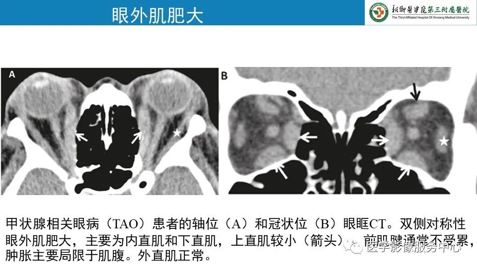 影像PPT - 【PPT】甲状腺免疫相关眼病-11