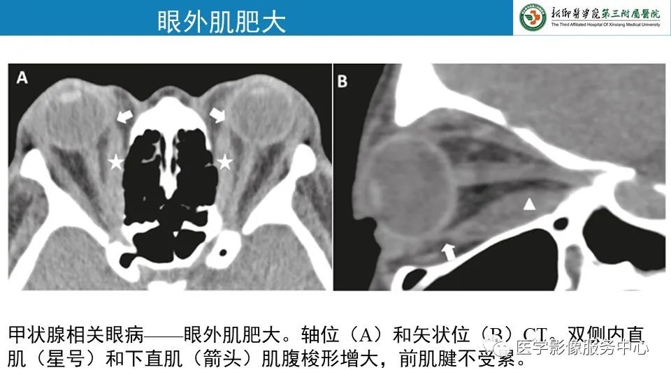 影像PPT - 【PPT】甲状腺免疫相关眼病-12