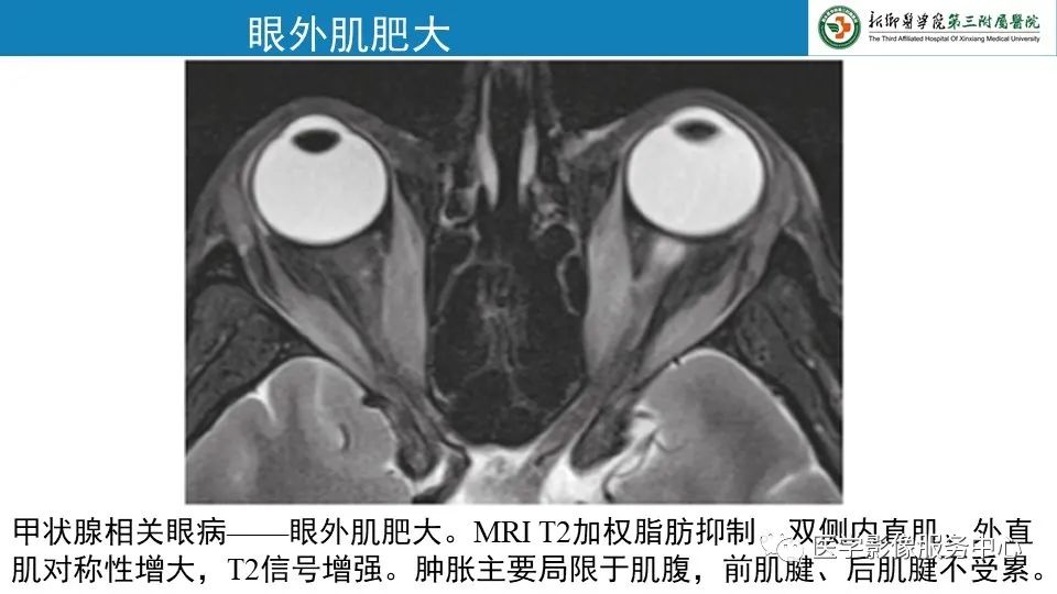 影像PPT - 【PPT】甲状腺免疫相关眼病-13