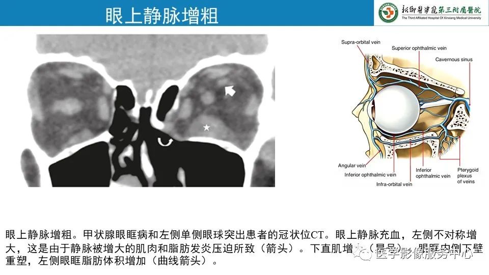 影像PPT - 【PPT】甲状腺免疫相关眼病-17