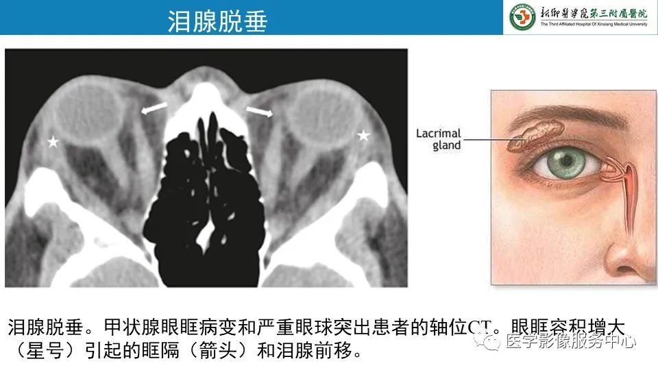 影像PPT - 【PPT】甲状腺免疫相关眼病-16