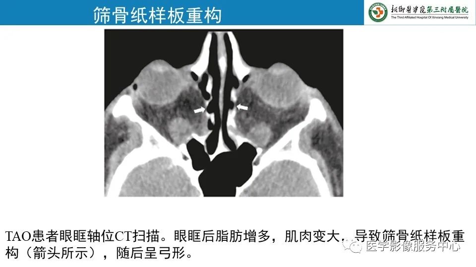 影像PPT - 【PPT】甲状腺免疫相关眼病-18