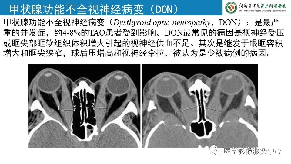 影像PPT - 【PPT】甲状腺免疫相关眼病-20