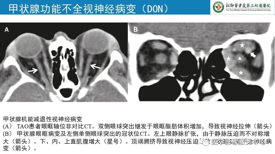 影像PPT - 【PPT】甲状腺免疫相关眼病-21
