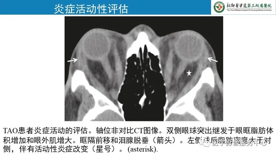 影像PPT - 【PPT】甲状腺免疫相关眼病-23