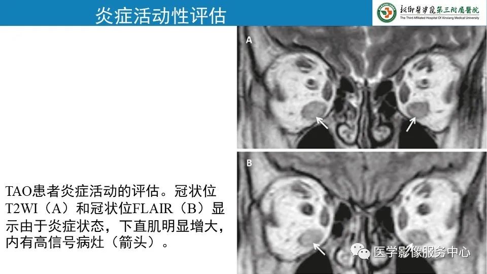 影像PPT - 【PPT】甲状腺免疫相关眼病-24