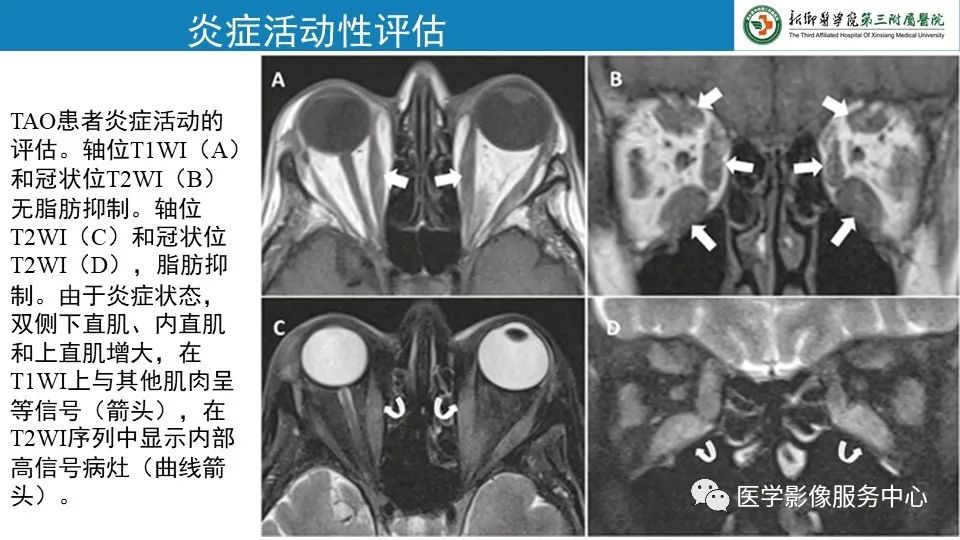 影像PPT - 【PPT】甲状腺免疫相关眼病-25