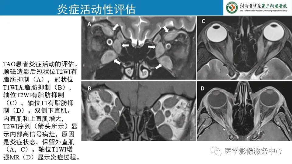 影像PPT - 【PPT】甲状腺免疫相关眼病-26