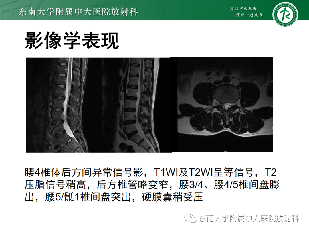 影像PPT - 【PPT】腰椎椎间盘突出/游离的影像诊断-3 影像PPT - 【PPT】腰椎椎间盘突出/游离的影像诊断-3