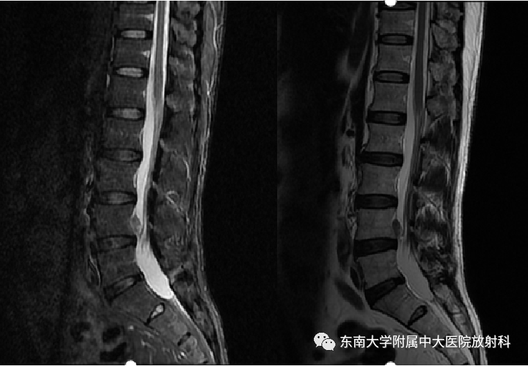 影像PPT - 【PPT】腰椎椎间盘突出/游离的影像诊断-1 影像PPT - 【PPT】腰椎椎间盘突出/游离的影像诊断-1