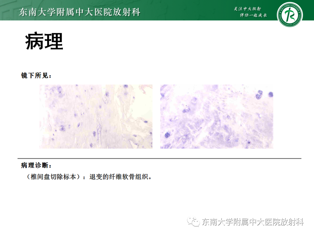 影像PPT - 【PPT】腰椎椎间盘突出/游离的影像诊断-4 影像PPT - 【PPT】腰椎椎间盘突出/游离的影像诊断-4