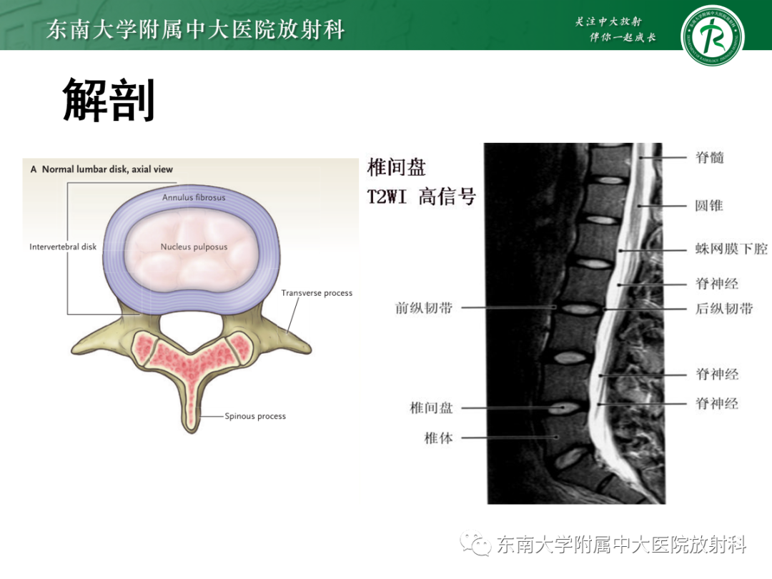 影像PPT - 【PPT】腰椎椎间盘突出/游离的影像诊断-7 影像PPT - 【PPT】腰椎椎间盘突出/游离的影像诊断-7