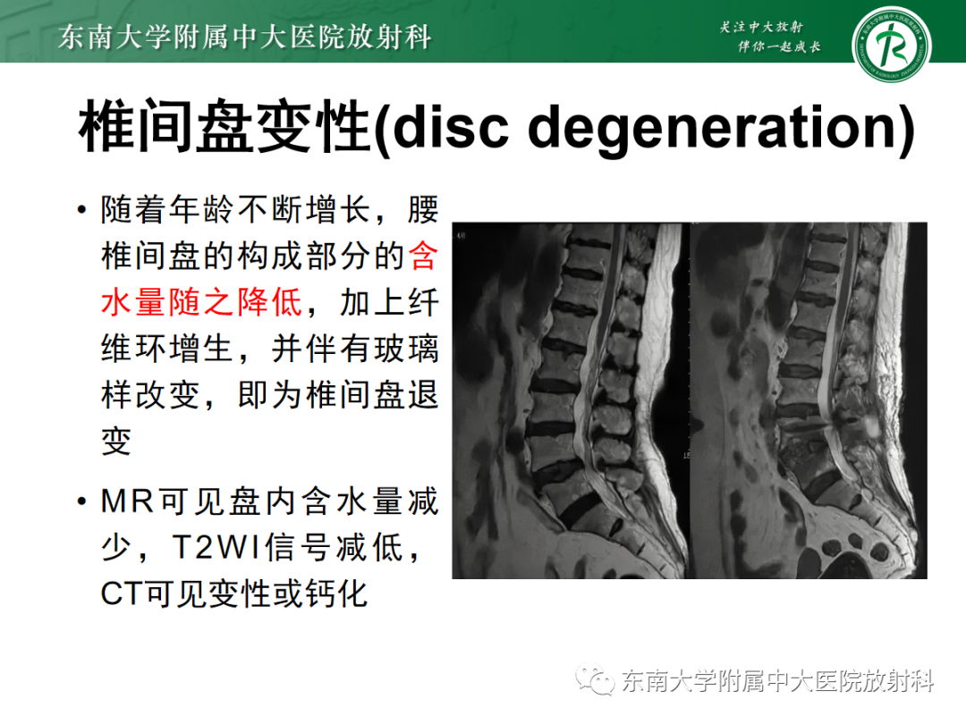 影像PPT - 【PPT】腰椎椎间盘突出/游离的影像诊断-11 影像PPT - 【PPT】腰椎椎间盘突出/游离的影像诊断-11
