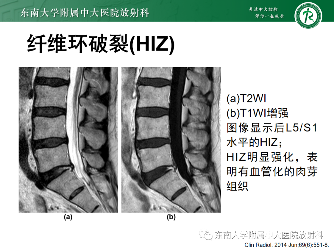 影像PPT - 【PPT】腰椎椎间盘突出/游离的影像诊断-13 影像PPT - 【PPT】腰椎椎间盘突出/游离的影像诊断-13