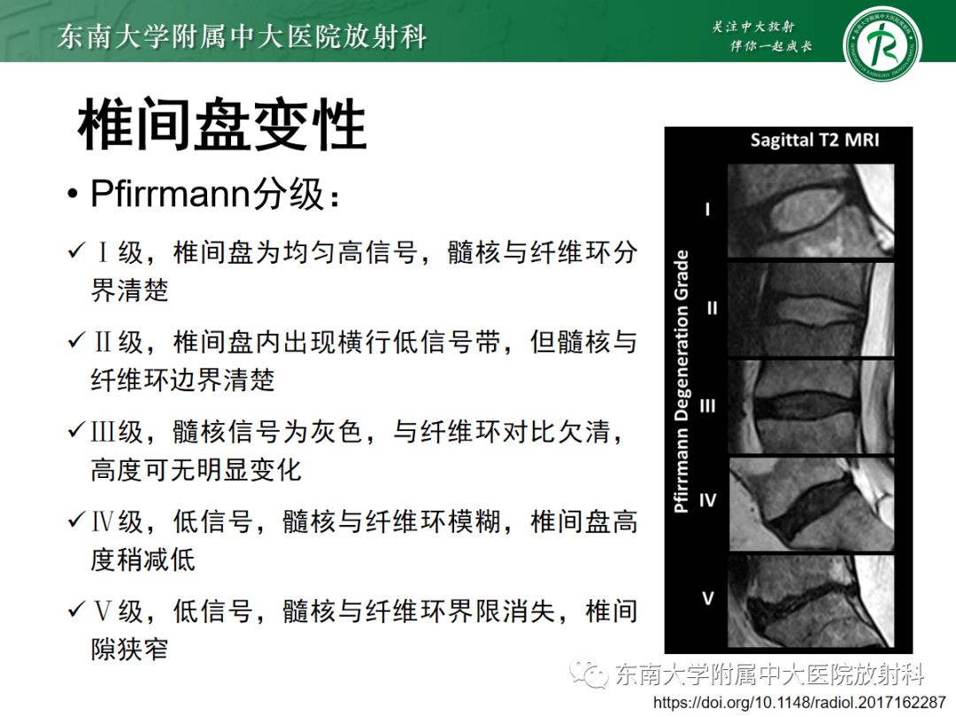 影像PPT - 【PPT】腰椎椎间盘突出/游离的影像诊断-14 影像PPT - 【PPT】腰椎椎间盘突出/游离的影像诊断-14