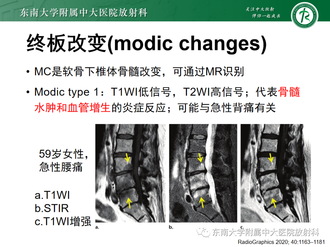 影像PPT - 【PPT】腰椎椎间盘突出/游离的影像诊断-15 影像PPT - 【PPT】腰椎椎间盘突出/游离的影像诊断-15