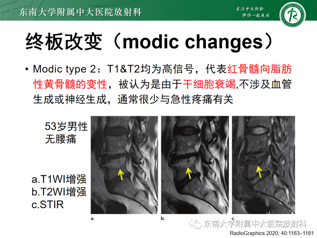影像PPT - 【PPT】腰椎椎间盘突出/游离的影像诊断-16 影像PPT - 【PPT】腰椎椎间盘突出/游离的影像诊断-16