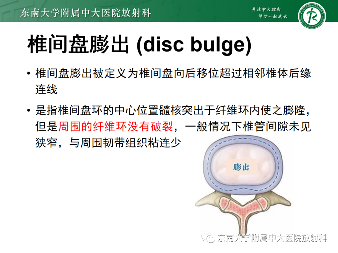 影像PPT - 【PPT】腰椎椎间盘突出/游离的影像诊断-18 影像PPT - 【PPT】腰椎椎间盘突出/游离的影像诊断-18