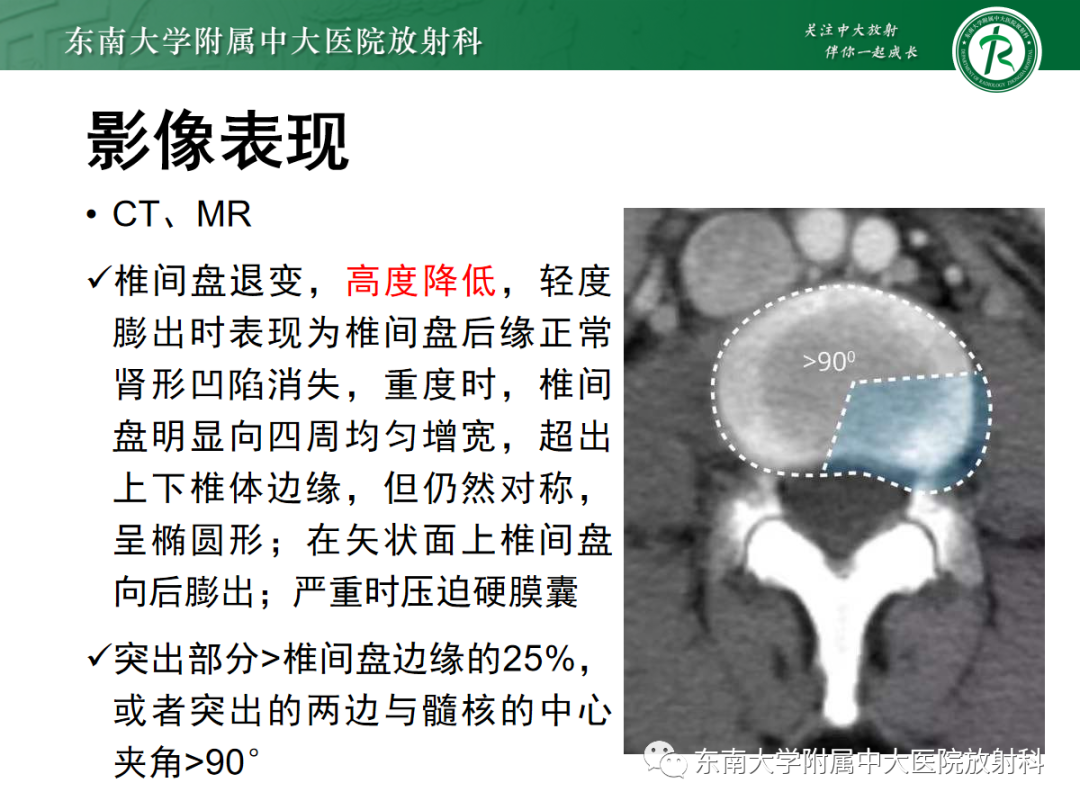 影像PPT - 【PPT】腰椎椎间盘突出/游离的影像诊断-19 影像PPT - 【PPT】腰椎椎间盘突出/游离的影像诊断-19