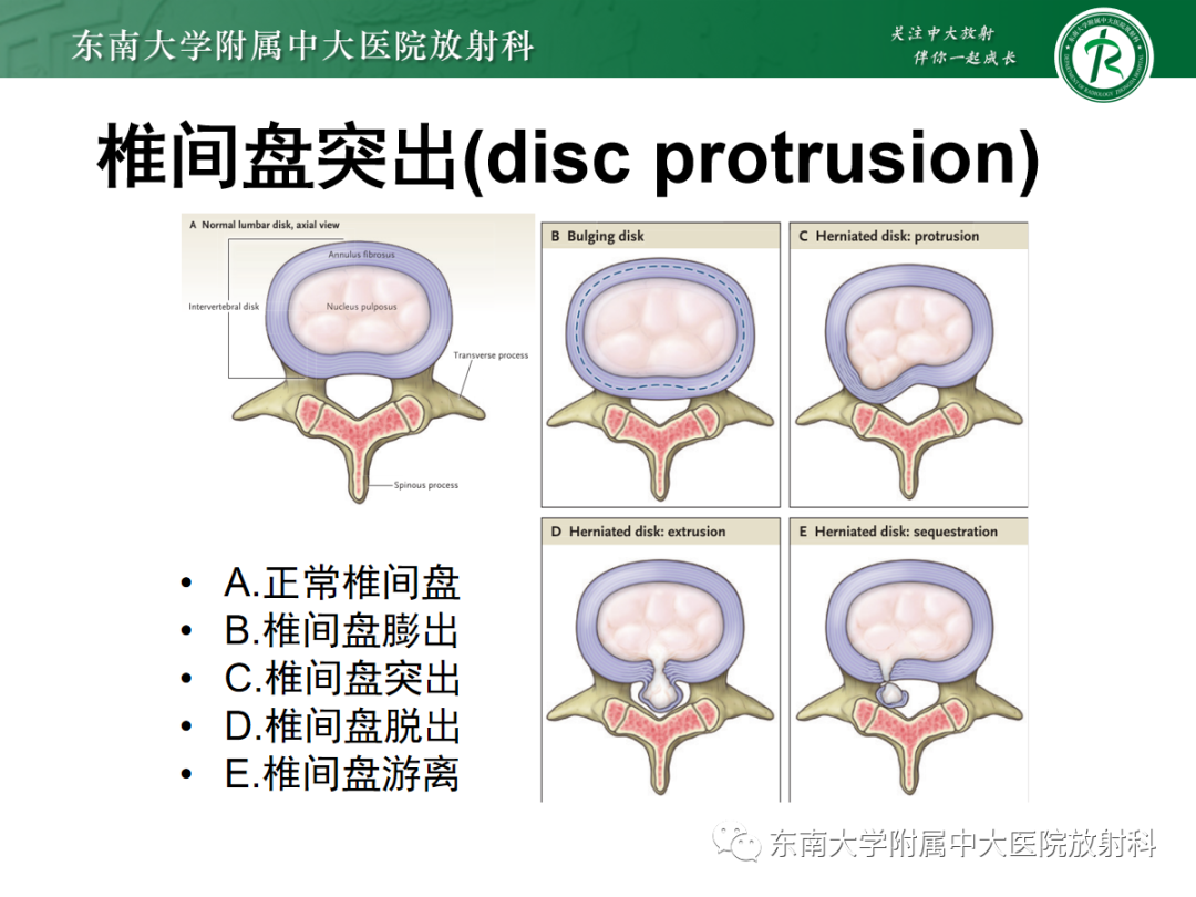 影像PPT - 【PPT】腰椎椎间盘突出/游离的影像诊断-21 影像PPT - 【PPT】腰椎椎间盘突出/游离的影像诊断-21