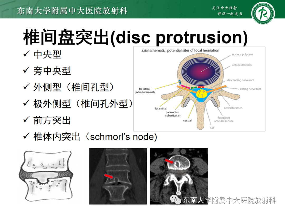 影像PPT - 【PPT】腰椎椎间盘突出/游离的影像诊断-22 影像PPT - 【PPT】腰椎椎间盘突出/游离的影像诊断-22