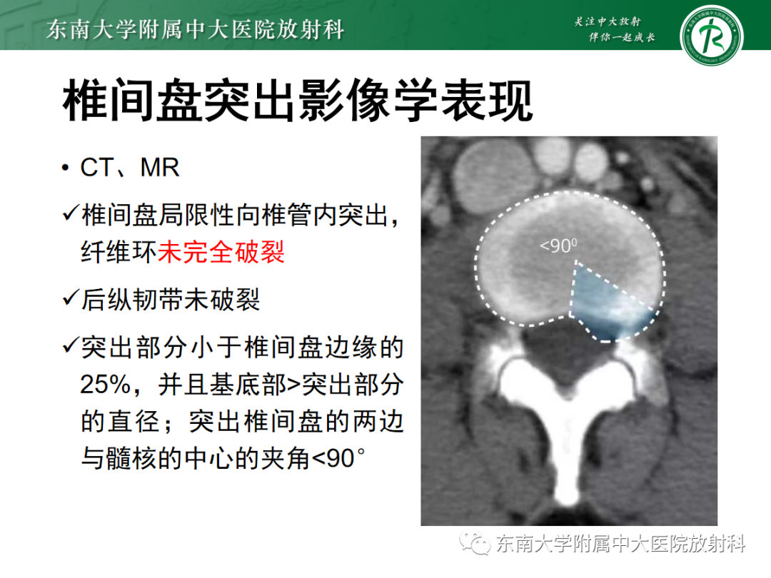 影像PPT - 【PPT】腰椎椎间盘突出/游离的影像诊断-23 影像PPT - 【PPT】腰椎椎间盘突出/游离的影像诊断-23