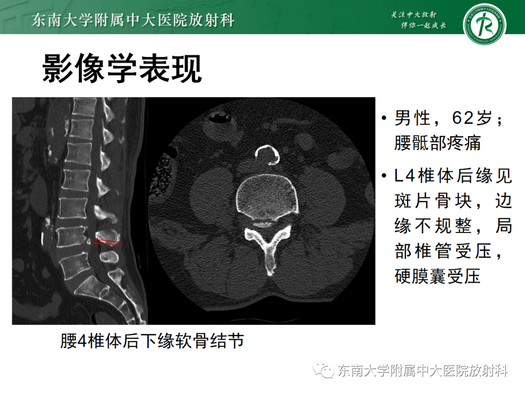 影像PPT - 【PPT】腰椎椎间盘突出/游离的影像诊断-26 影像PPT - 【PPT】腰椎椎间盘突出/游离的影像诊断-26
