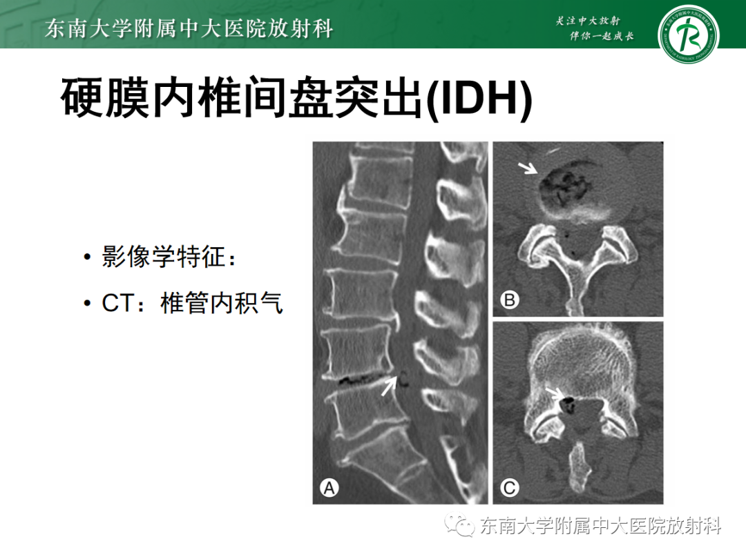 影像PPT - 【PPT】腰椎椎间盘突出/游离的影像诊断-28 影像PPT - 【PPT】腰椎椎间盘突出/游离的影像诊断-28