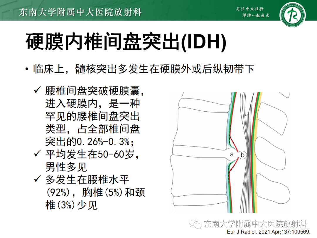 影像PPT - 【PPT】腰椎椎间盘突出/游离的影像诊断-27 影像PPT - 【PPT】腰椎椎间盘突出/游离的影像诊断-27