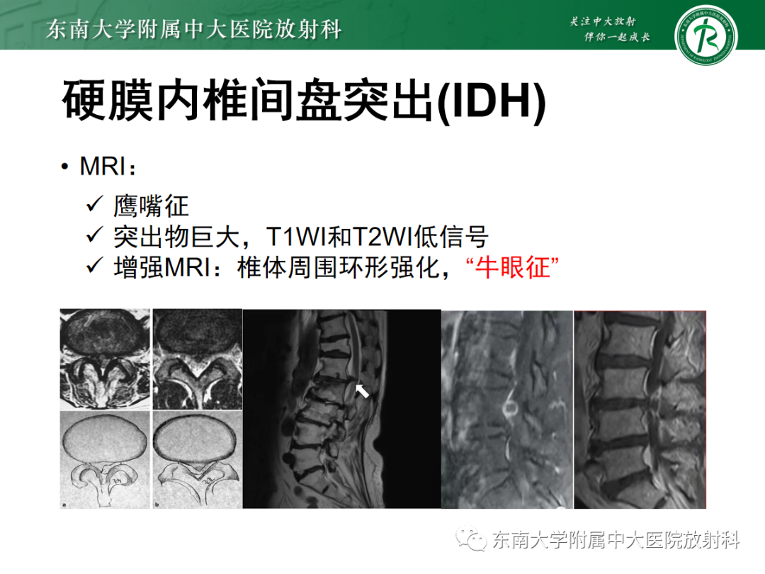 影像PPT - 【PPT】腰椎椎间盘突出/游离的影像诊断-29 影像PPT - 【PPT】腰椎椎间盘突出/游离的影像诊断-29