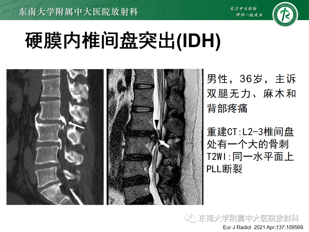 影像PPT - 【PPT】腰椎椎间盘突出/游离的影像诊断-30 影像PPT - 【PPT】腰椎椎间盘突出/游离的影像诊断-30