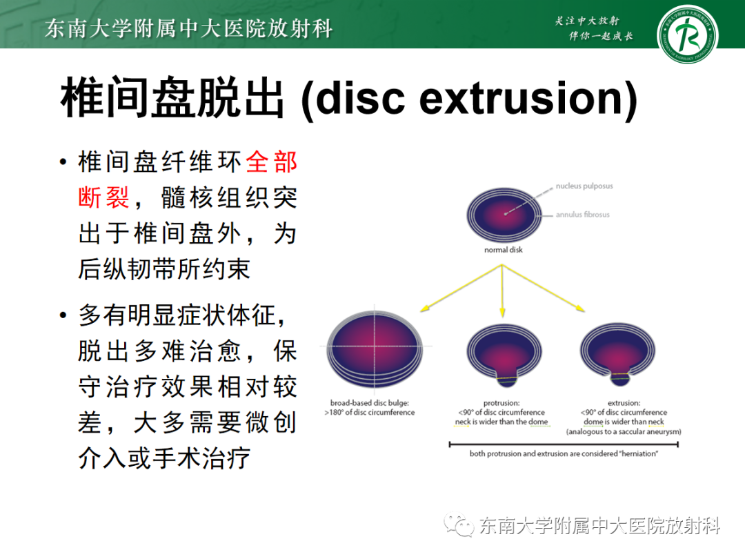 影像PPT - 【PPT】腰椎椎间盘突出/游离的影像诊断-31 影像PPT - 【PPT】腰椎椎间盘突出/游离的影像诊断-31
