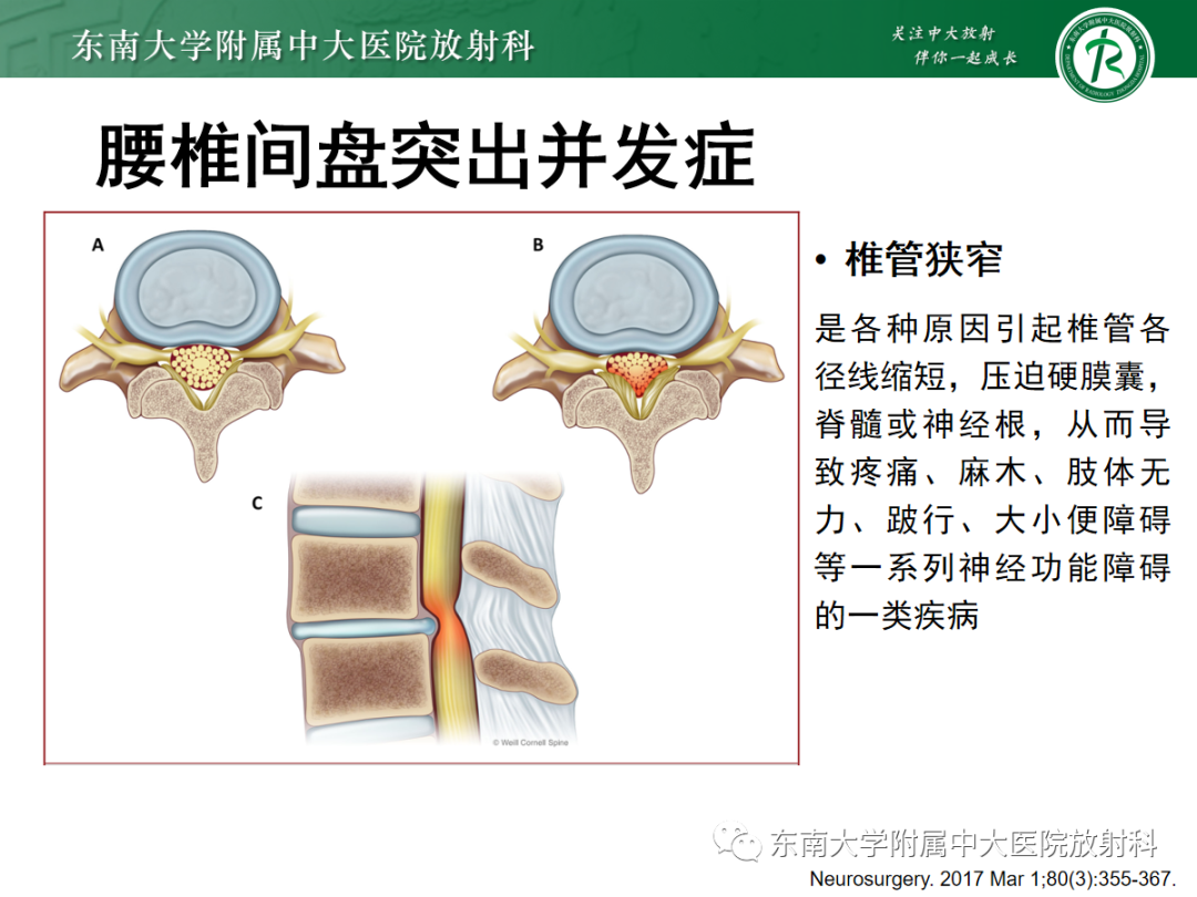 影像PPT - 【PPT】腰椎椎间盘突出/游离的影像诊断-34 影像PPT - 【PPT】腰椎椎间盘突出/游离的影像诊断-34