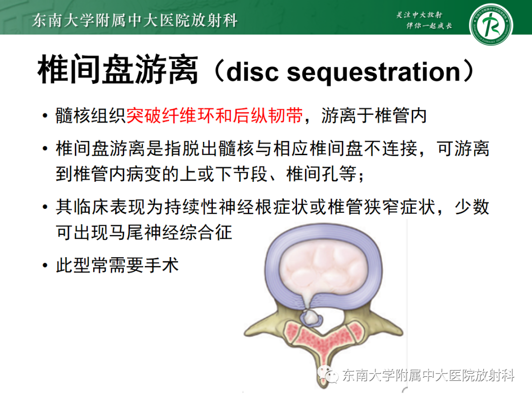 影像PPT - 【PPT】腰椎椎间盘突出/游离的影像诊断-33 影像PPT - 【PPT】腰椎椎间盘突出/游离的影像诊断-33