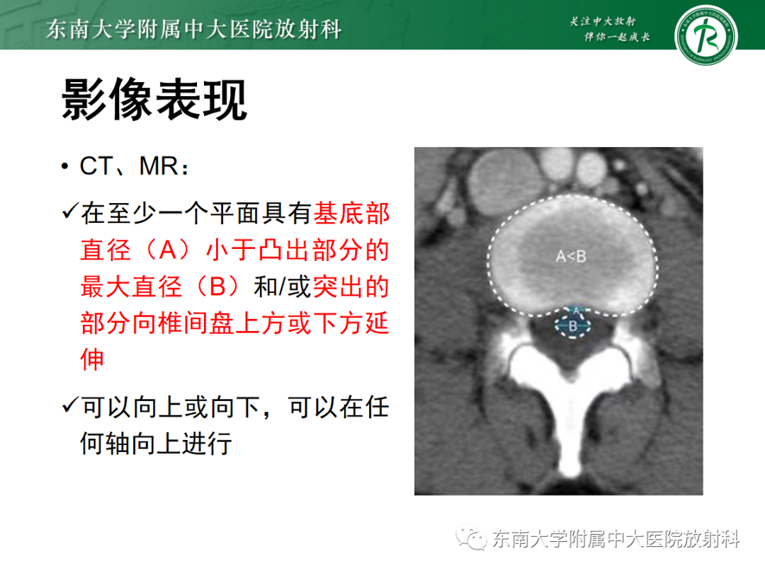 影像PPT - 【PPT】腰椎椎间盘突出/游离的影像诊断-32 影像PPT - 【PPT】腰椎椎间盘突出/游离的影像诊断-32