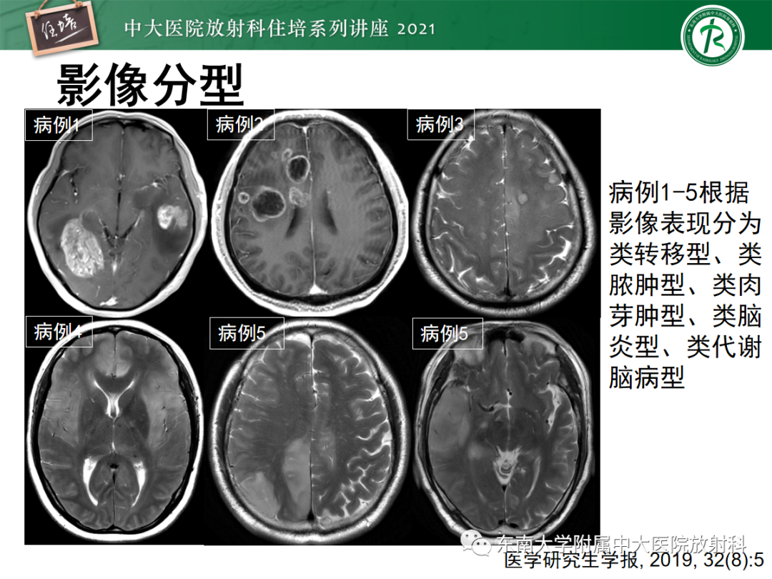 影像PPT - 【PPT】颅内多发占位的影像诊断-10