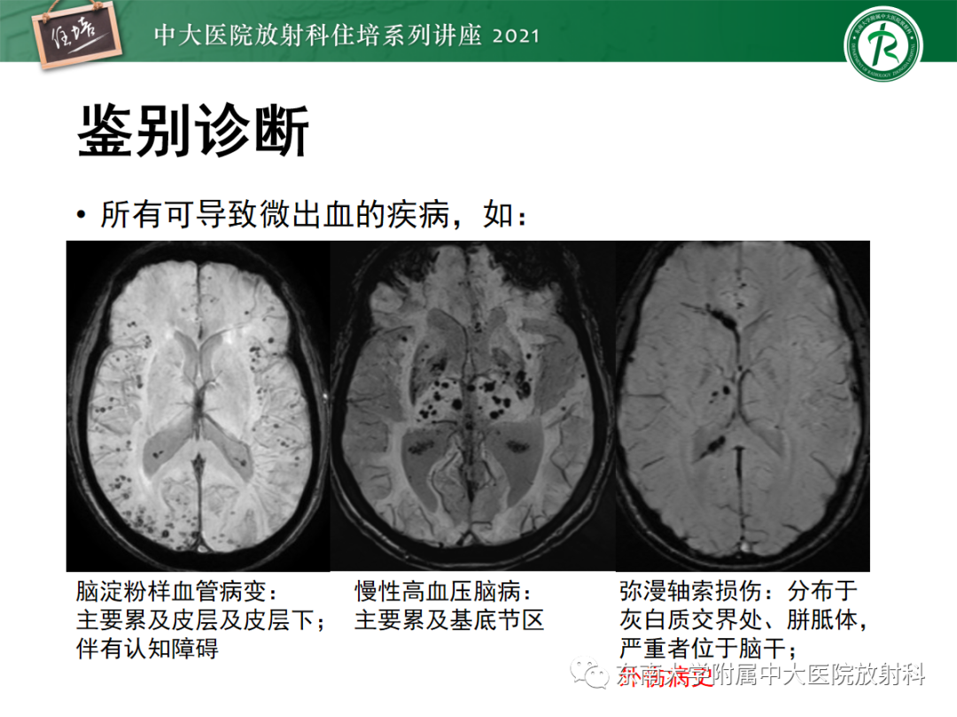影像PPT - 【PPT】颅内多发占位的影像诊断-19